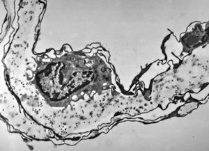 F,47y. | arachnoid cyst